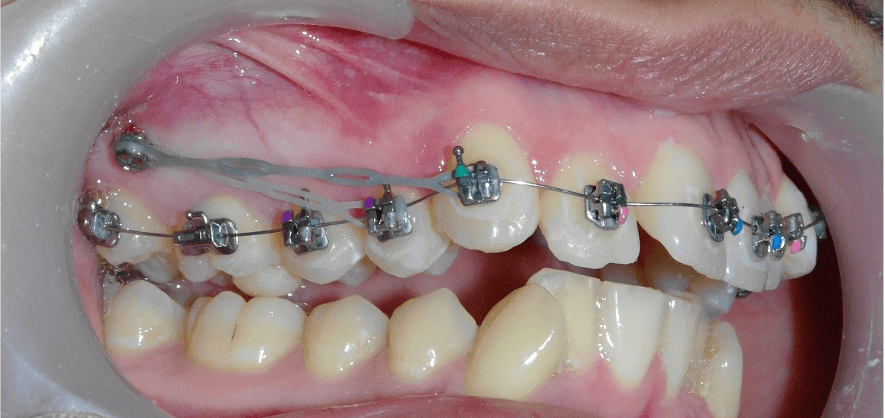 Les Mini-vis orthodontiques