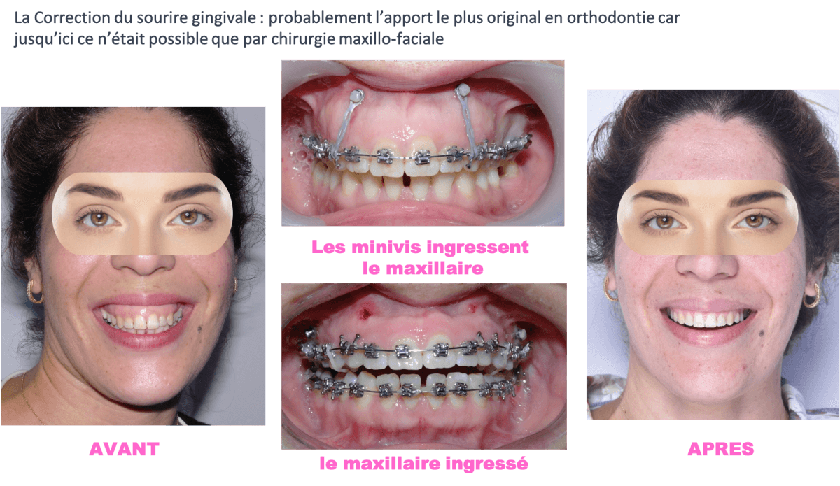 Mini-vis et ancrages osseux - CISCO - Formation en orthodontie en France,  formation orthodontie à Paris, formation d'orthodontiste